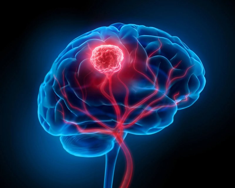 Tumores cerebrais